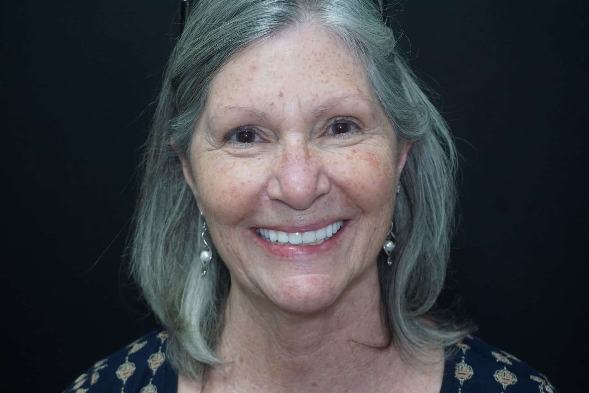 JoAnn G Showing off her briliant smile with All-on-x from Dr. Seale in Rincon GA