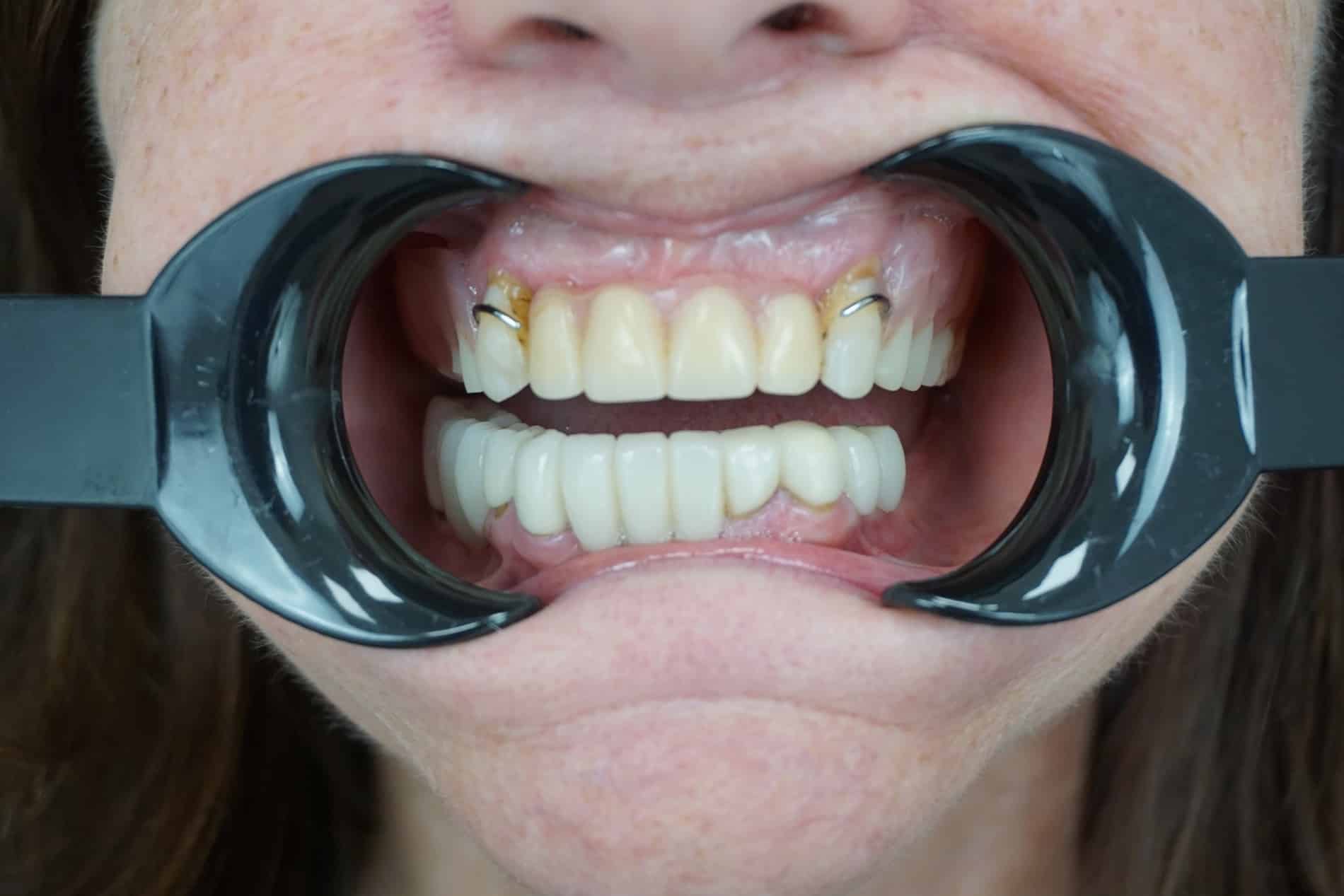 Before All-on-x close up of JoAnn's teeth in Rincon GA