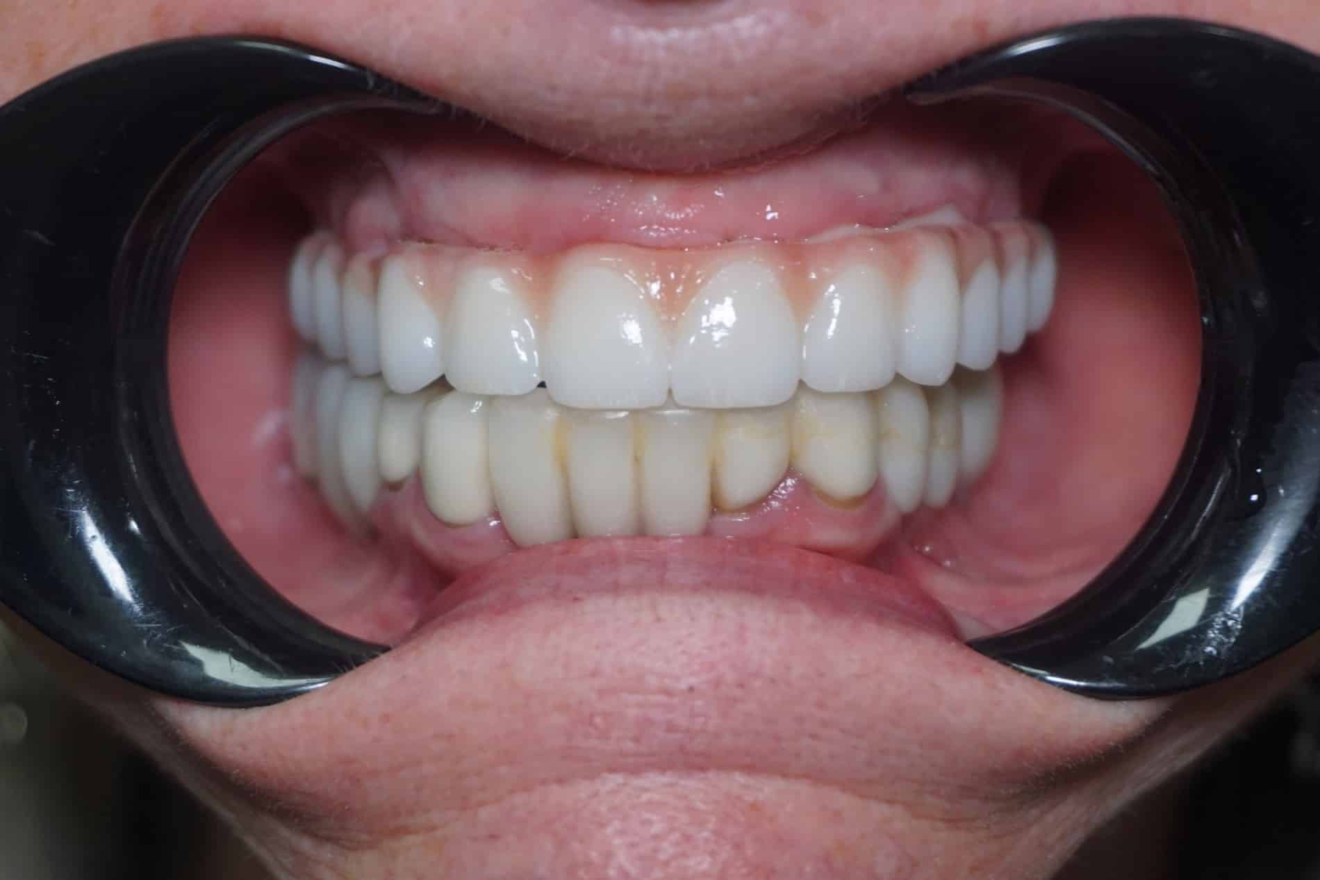 After All-on-x close up of JoAnn's teeth in Rincon GA