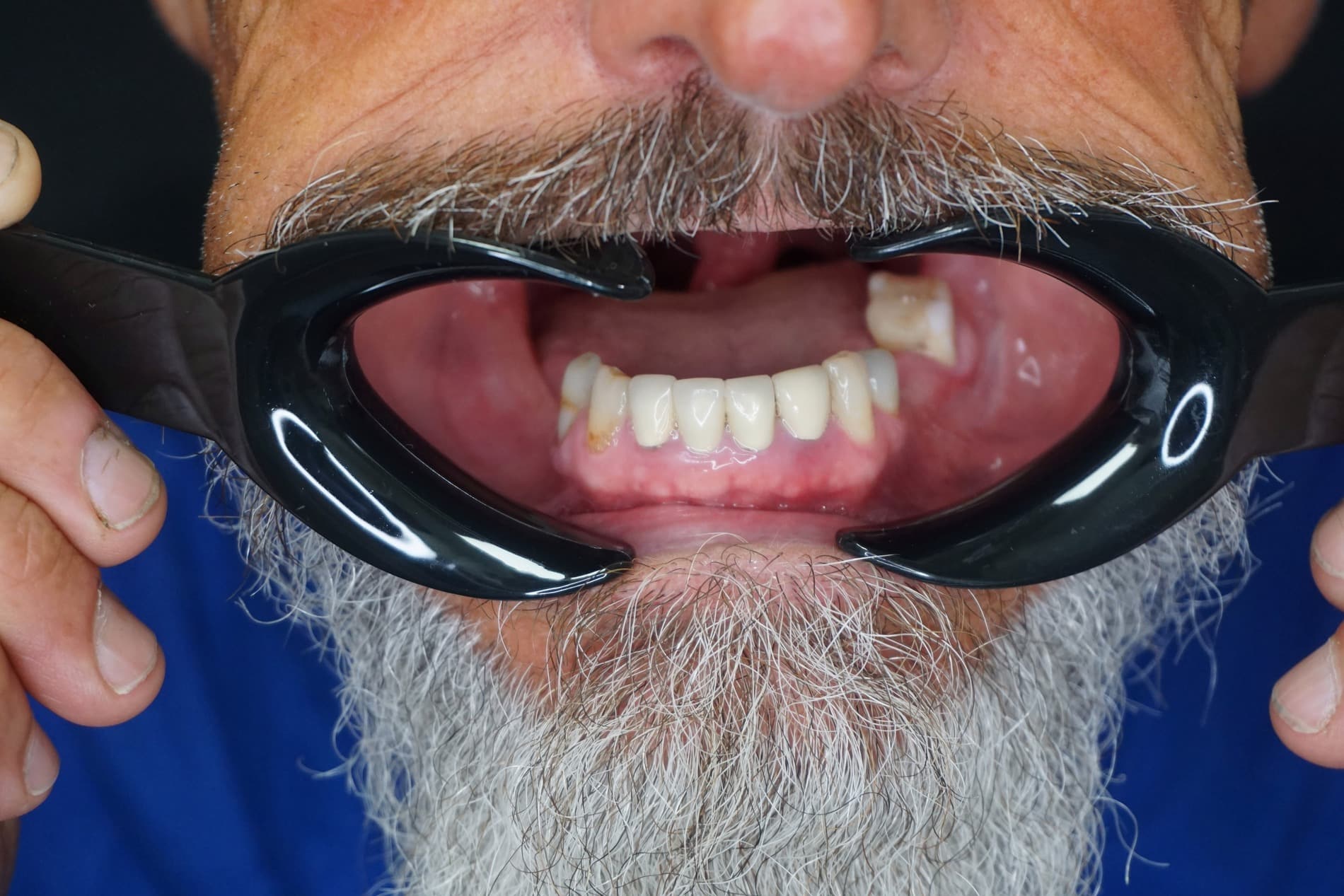 photos_2 Johns smile before dental impants with Dr. Seale in Rincon GA