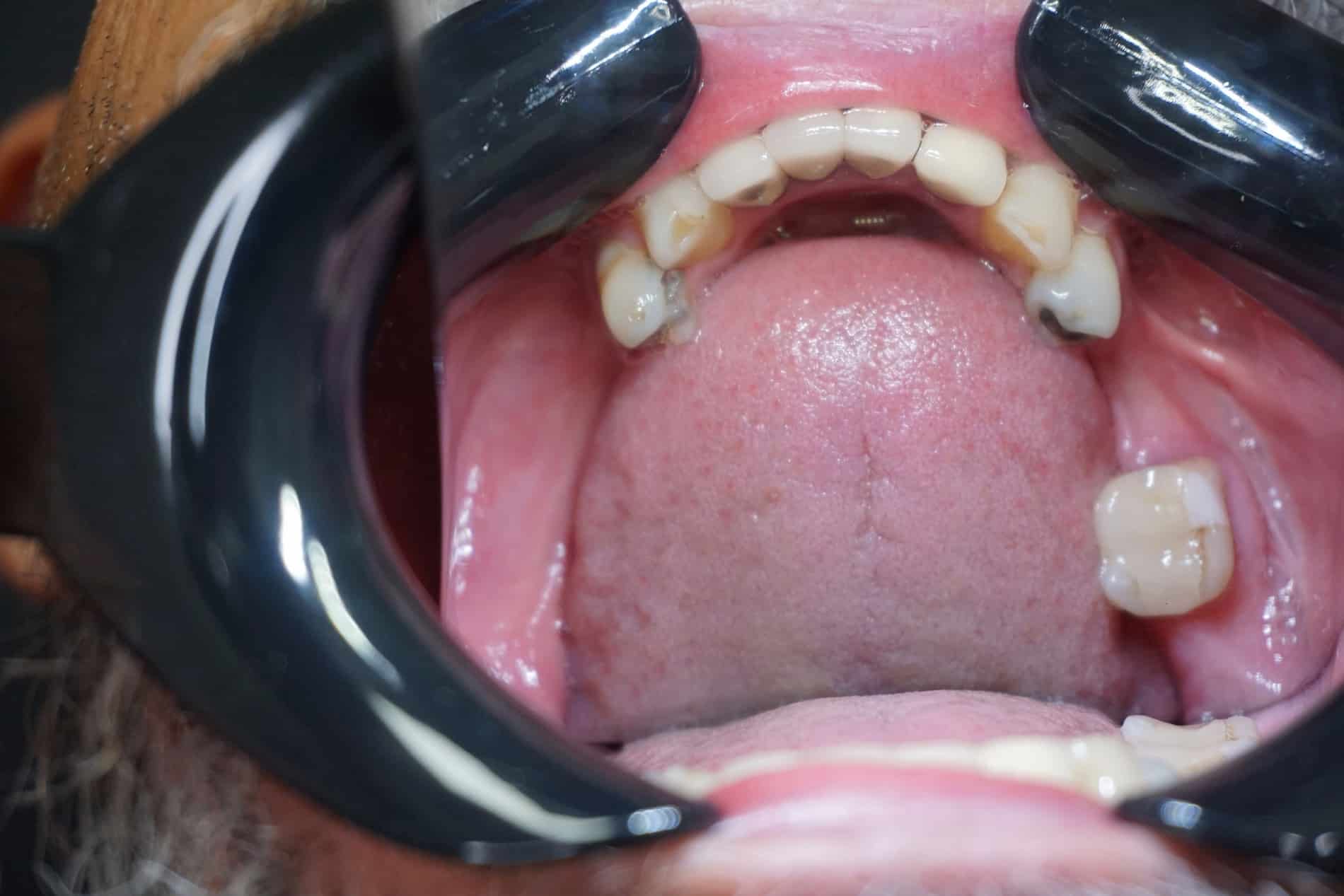 Johns mouth before a implant bridge in Rincon GA