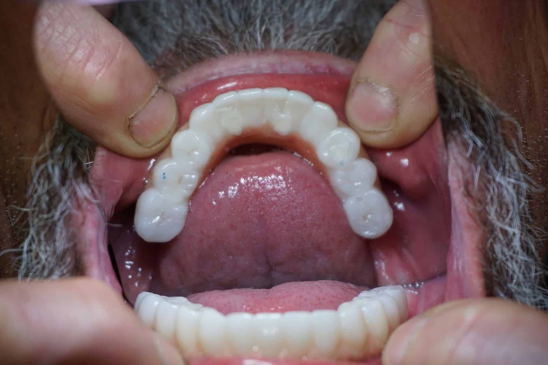 Johns mouth after a implant bridge in Rincon GA