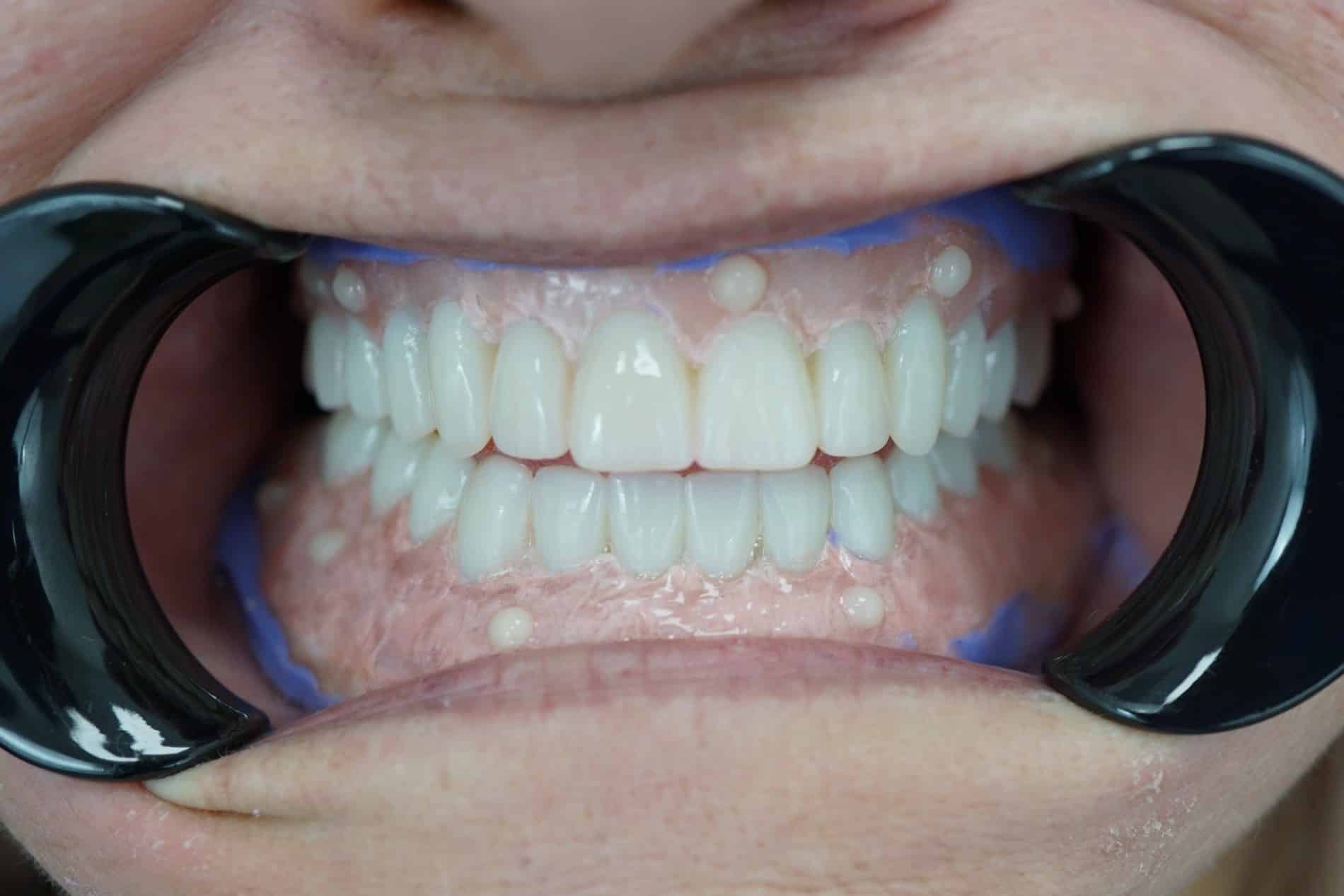 Close up of Wendy's try in dentures at iHeart Dental in Rincon GA