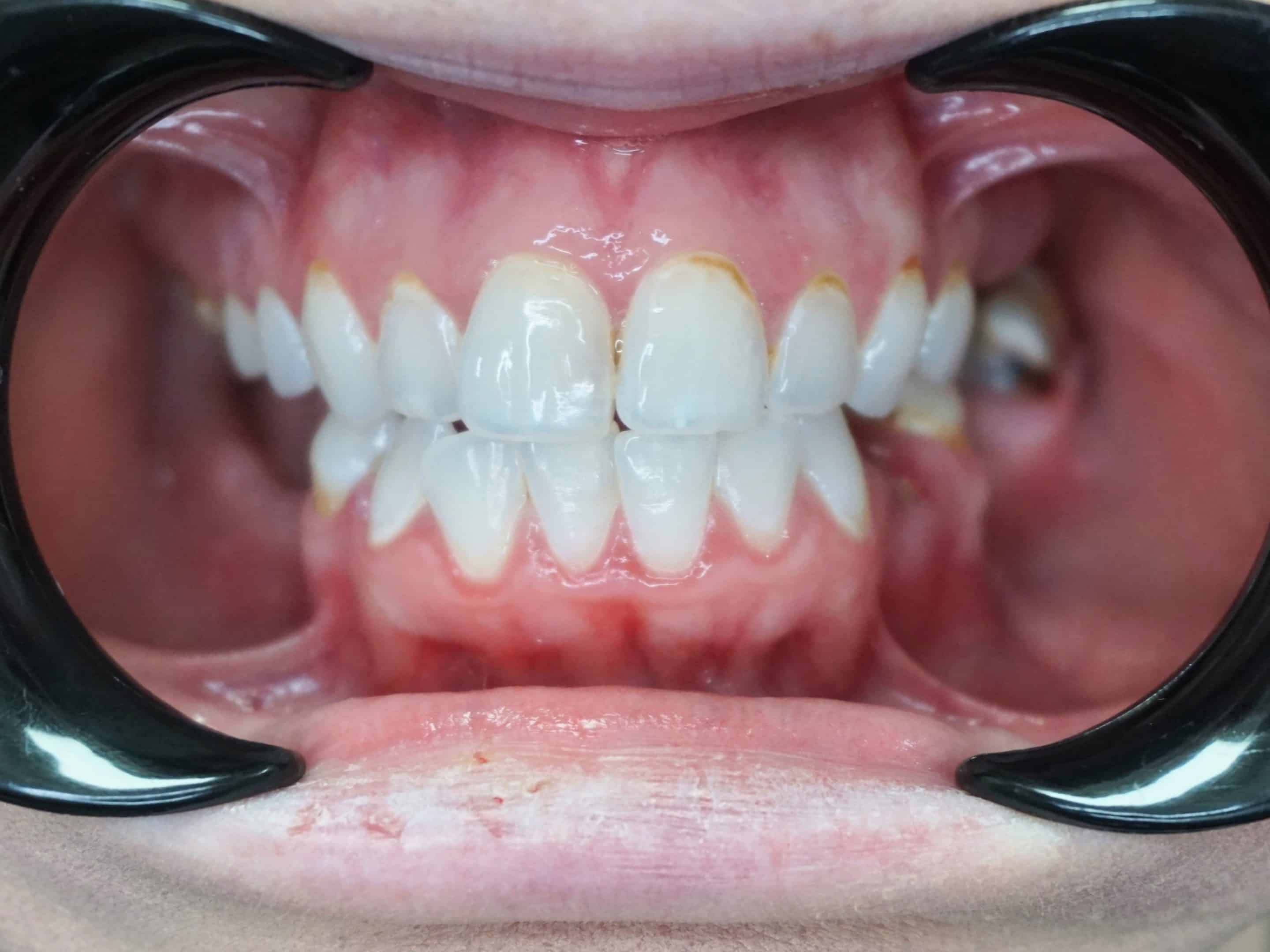 Lena before inplants pictures