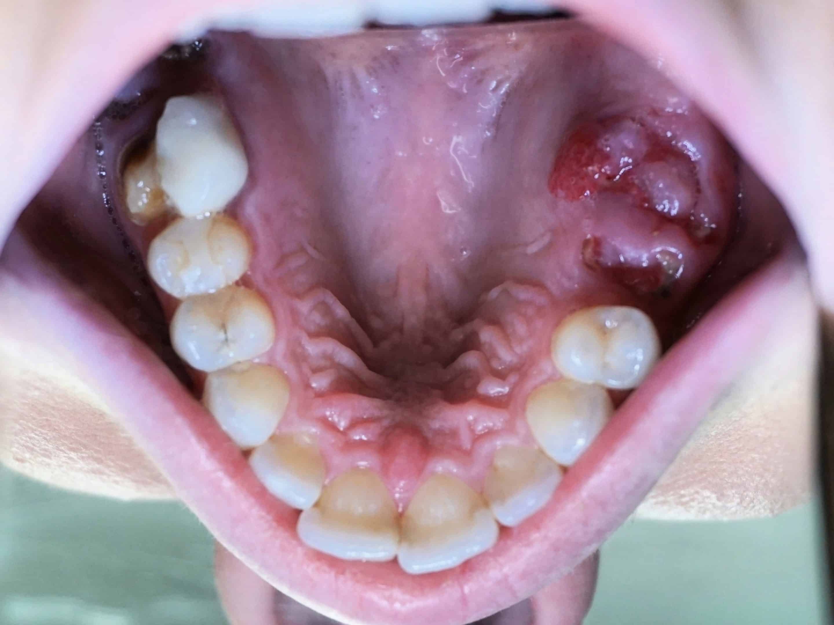 Lena before inplants pictures