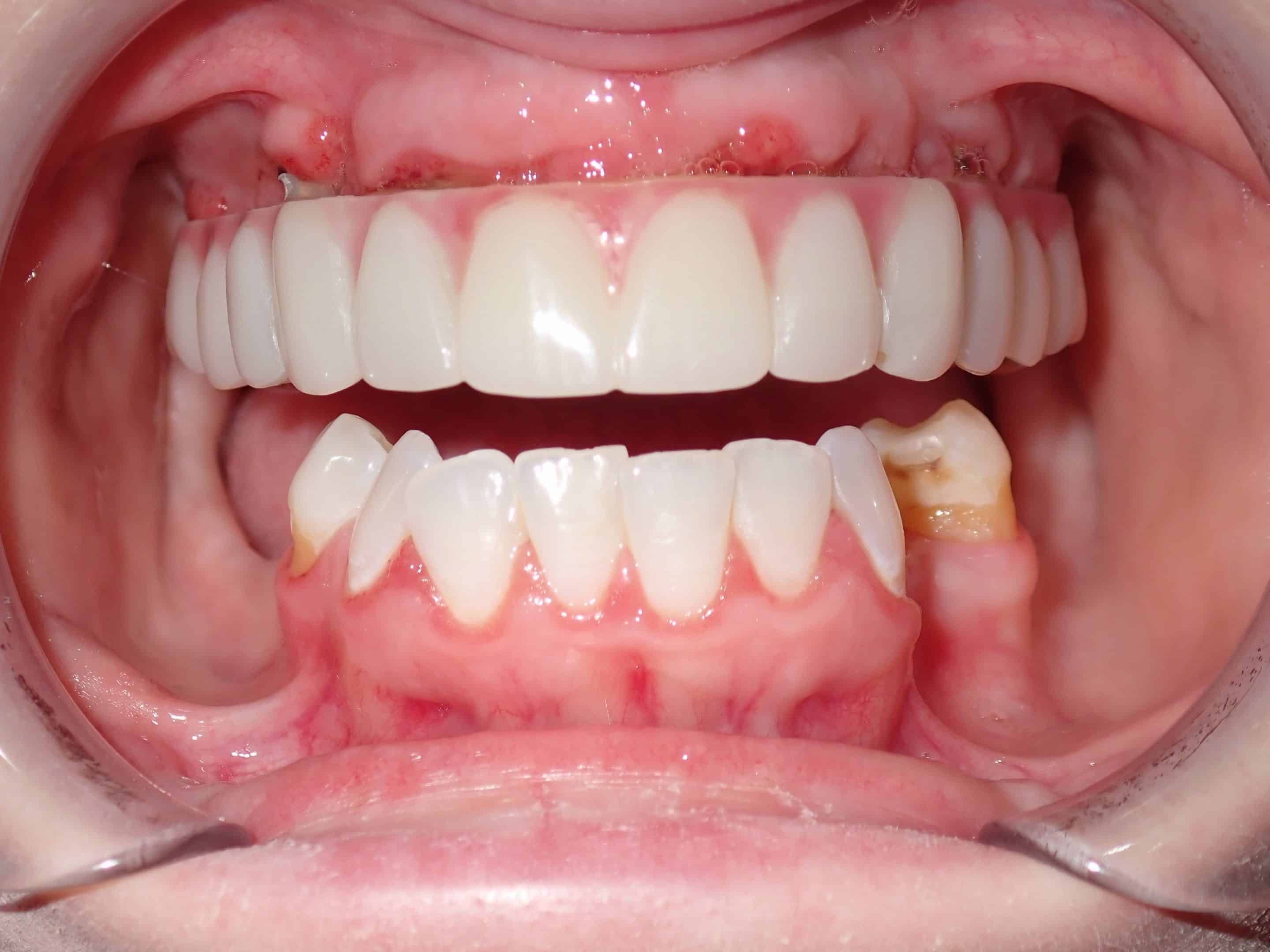 Lena after inplants pictures